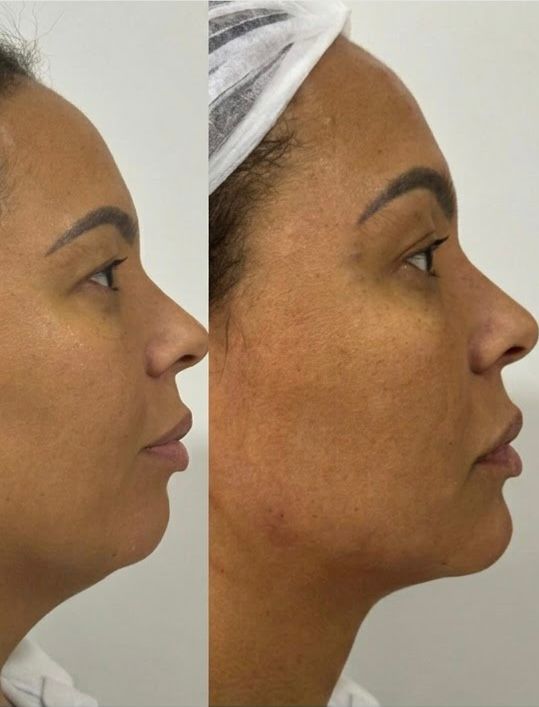 Harmonização Facial