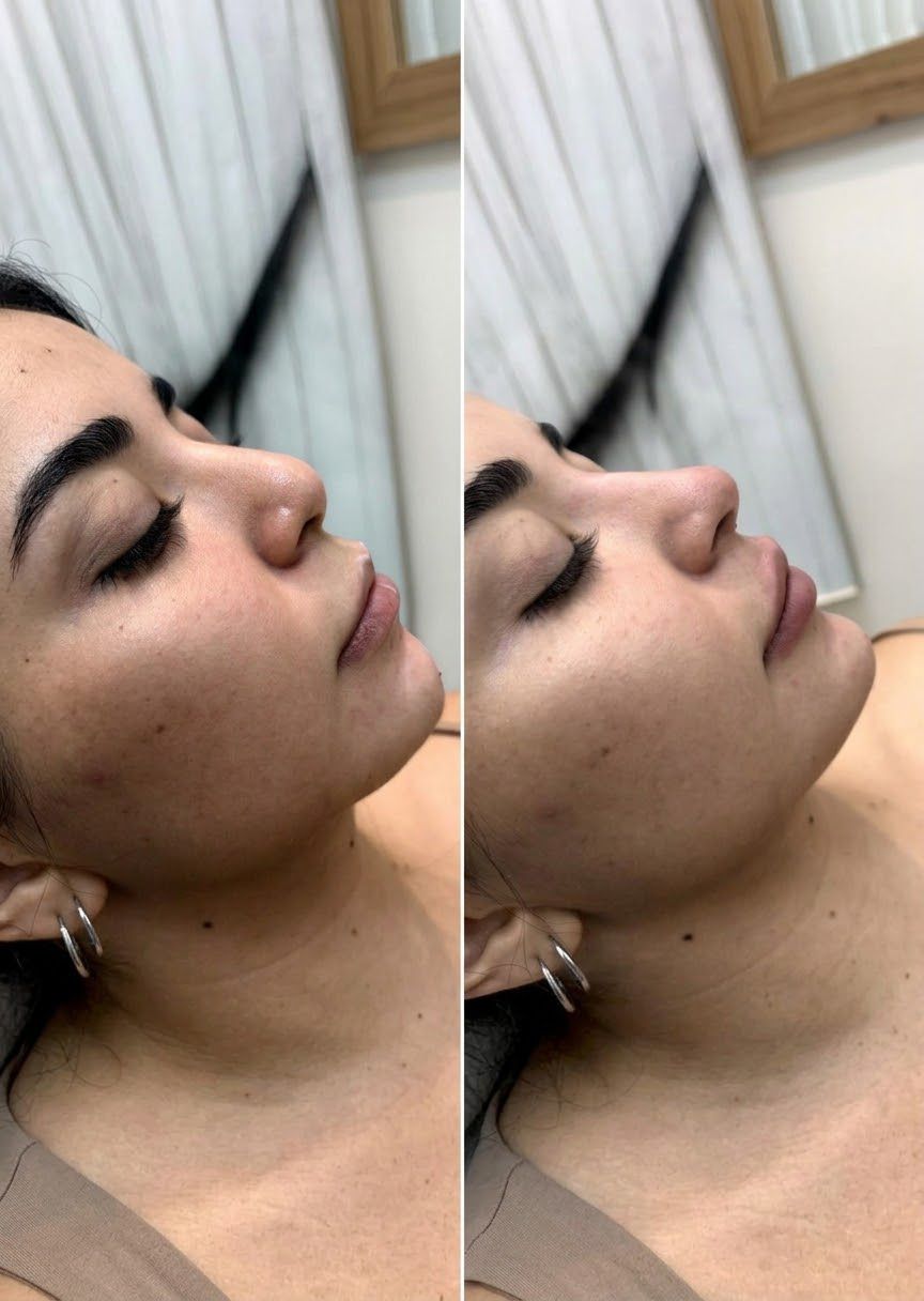 Perfiloplastia